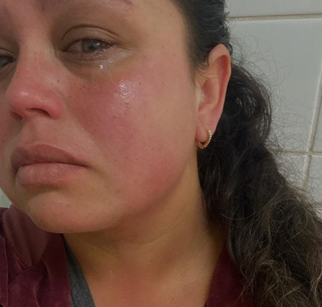 Rosto de mulher que recebeu spray de pimenta no rosto de GCM de São José