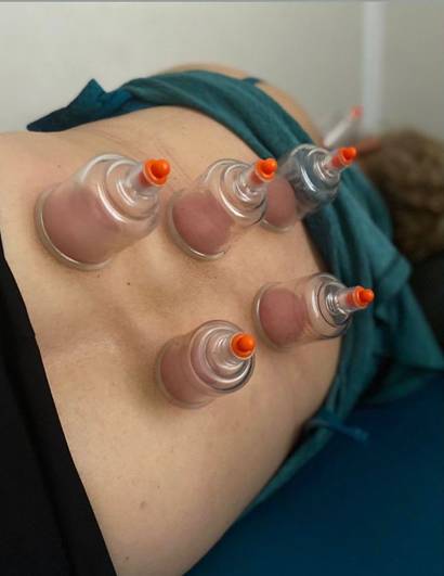 Tratamento com ventosas feito por Mariana Campos, em SJC