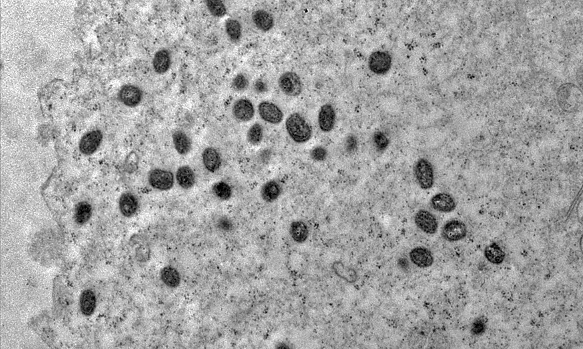 Vírus da Monkeypox; Lorena no Vale do Paraíba, confirmou primeiro caso da doença em 2024